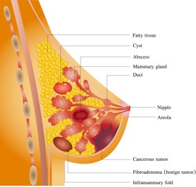 breast-cancer-dreamstime